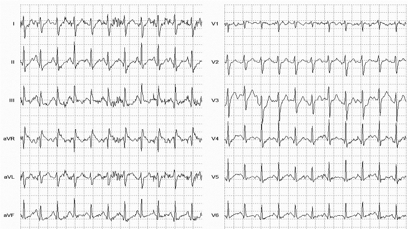 Sinus Tachycardia 12 Lead EKG